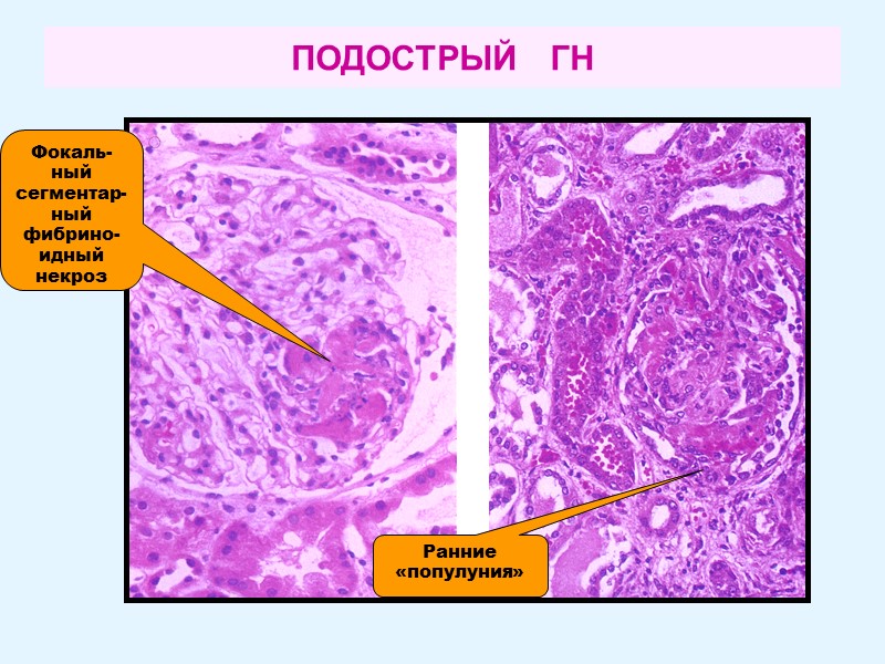 ПОДОСТРЫЙ   ГН Фокаль- ный сегментар- ный фибрино-идный некроз Ранние «популуния»